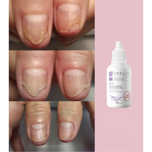 Shelly Stop Onycholyse Öl mit Farnesol und Teebaumöl, 30 ml